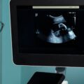 Test genetico pre-impianto: l’indagine sullo stato di salute dell’embrione. Ecco perché farla a prescindere dal numero di embrioni ottenuti